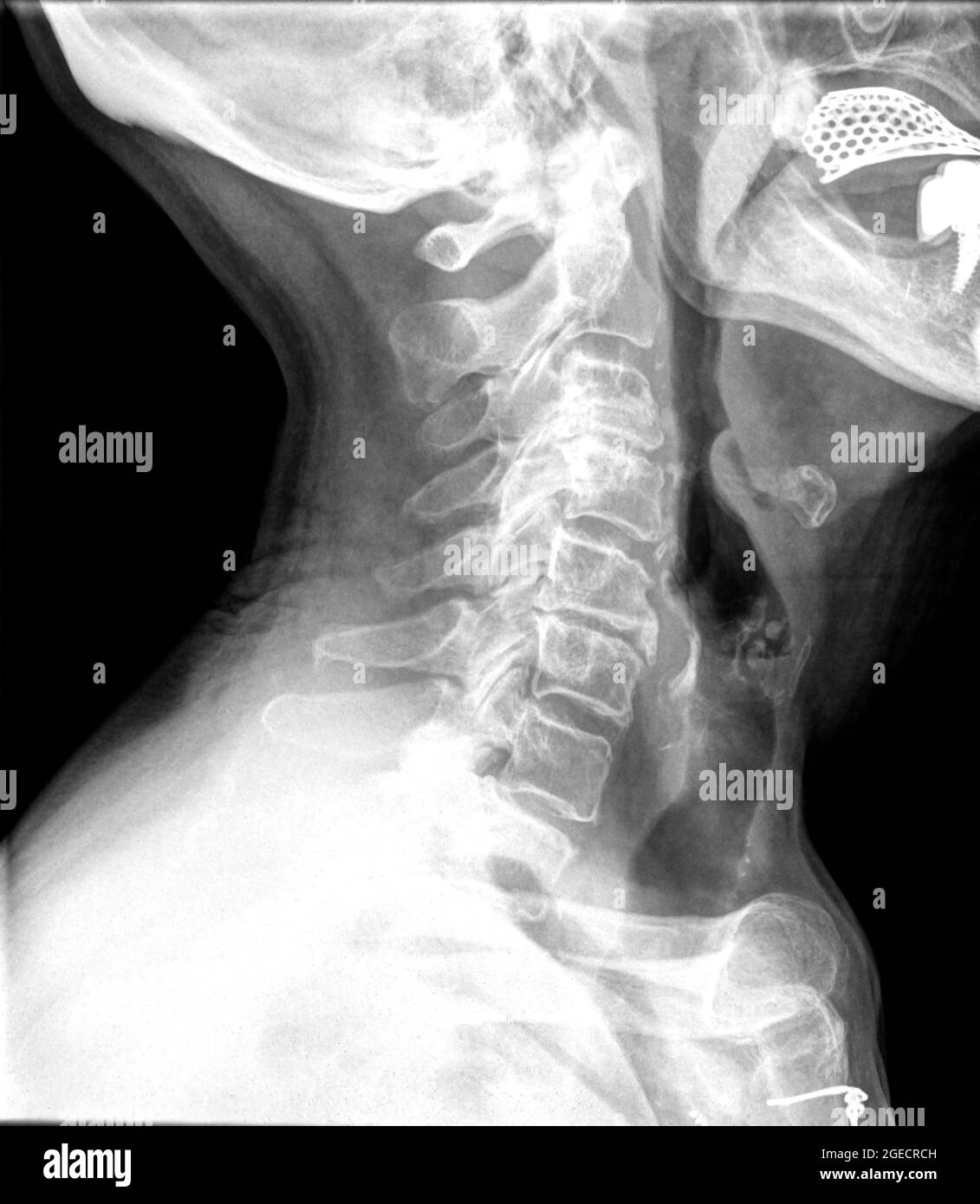 Röntgenaufnahme der Halswirbelsäule einer 72 Jahre alten weiblichen Patientin Stockfoto