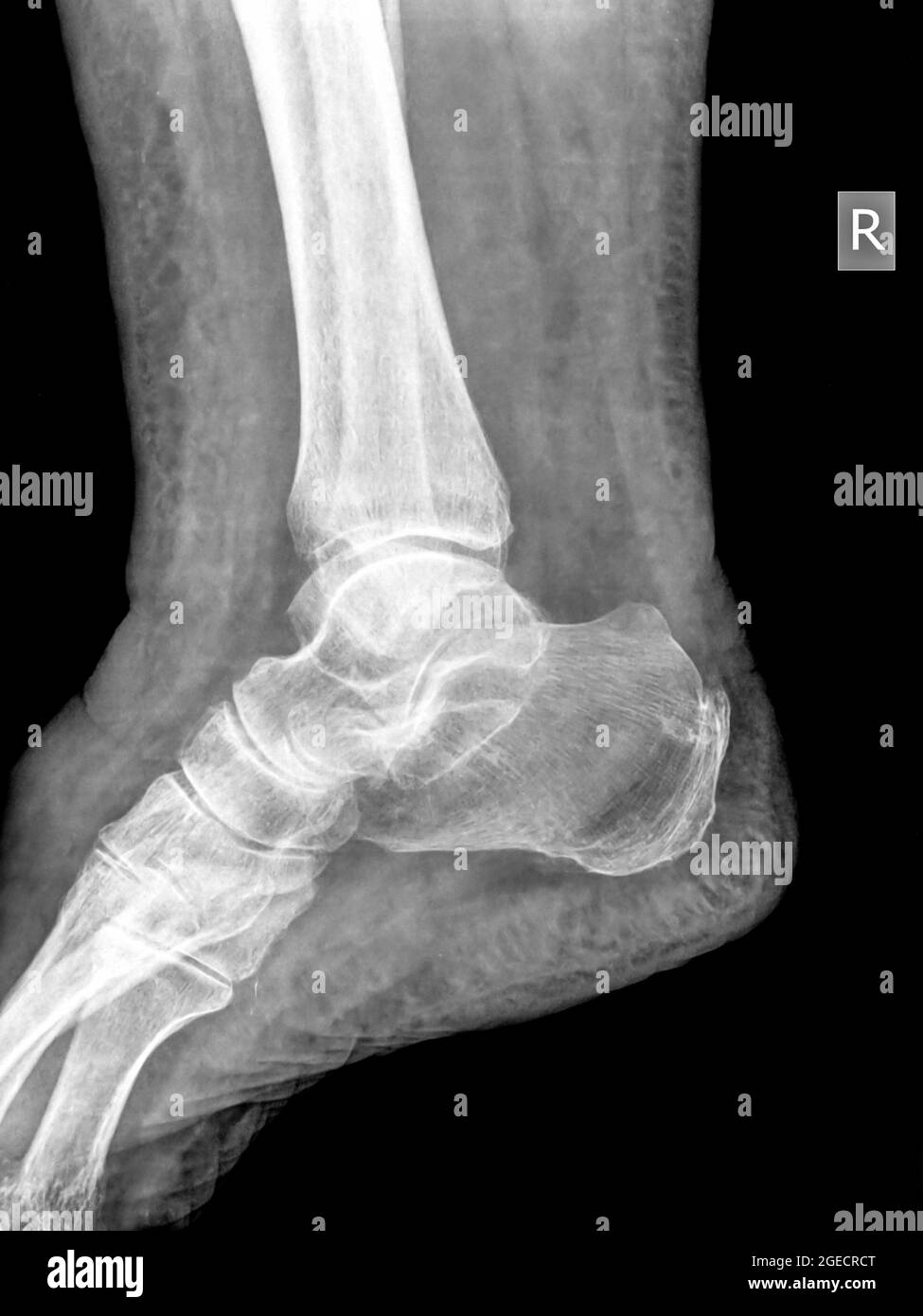 Gesunde Sprunggelenk x-ray von einem 79 Jahre alten weiblichen Patienten. Kein Bruch noch Verstauchung gesehen werden kann Stockfoto