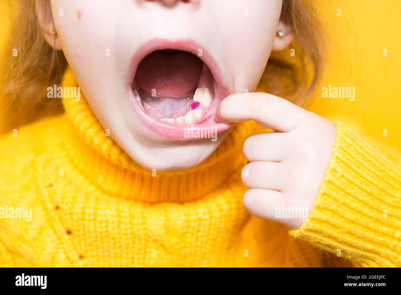 Farbige violette Füllung auf dem Milchkauen des Mädchens. Kinderzahnheilkunde, Behandlung und Untersuchung. Ein Kind mit offenem Mund zeigt einen Zahn in c Stockfoto