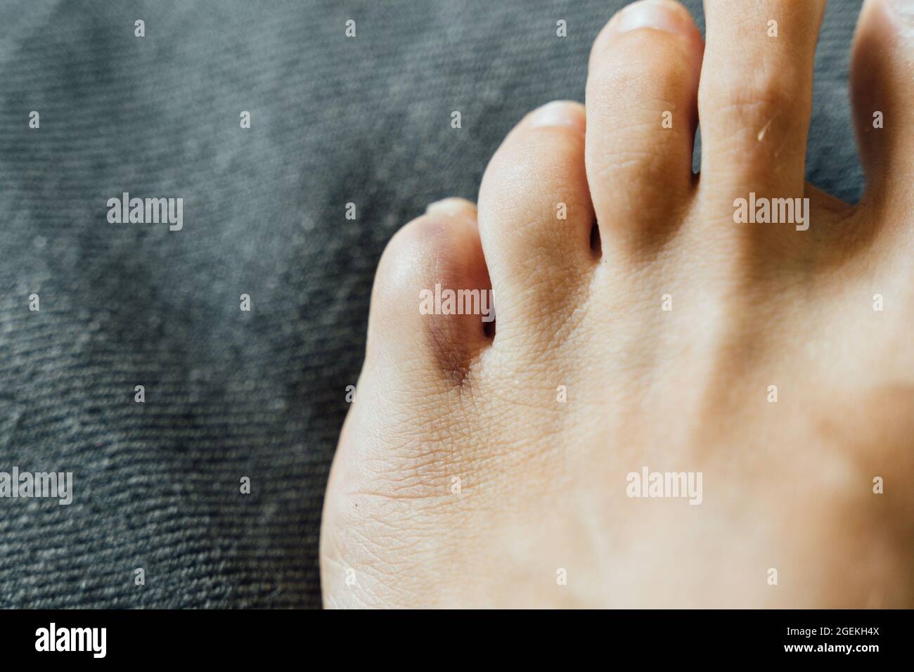 Fußverletzung mit kleinen Fingern. Kleine Zehen Schmerzen und Blutergüsse nach Hausunfall. Fraktur des Kluftbeins. Barfuß Fingernägel gesund. Stockfoto
