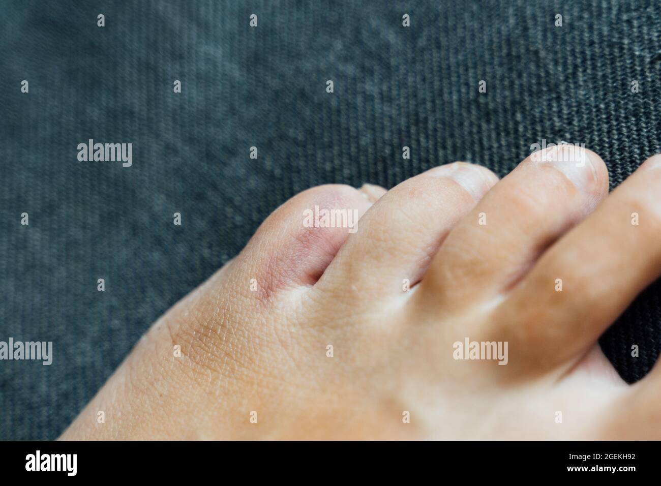 Fußverletzung mit kleinen Fingern. Kleine Zehen Schmerzen und Blutergüsse nach Hausunfall. Fraktur des Kluftbeins. Barfuß Fingernägel gesund. Stockfoto
