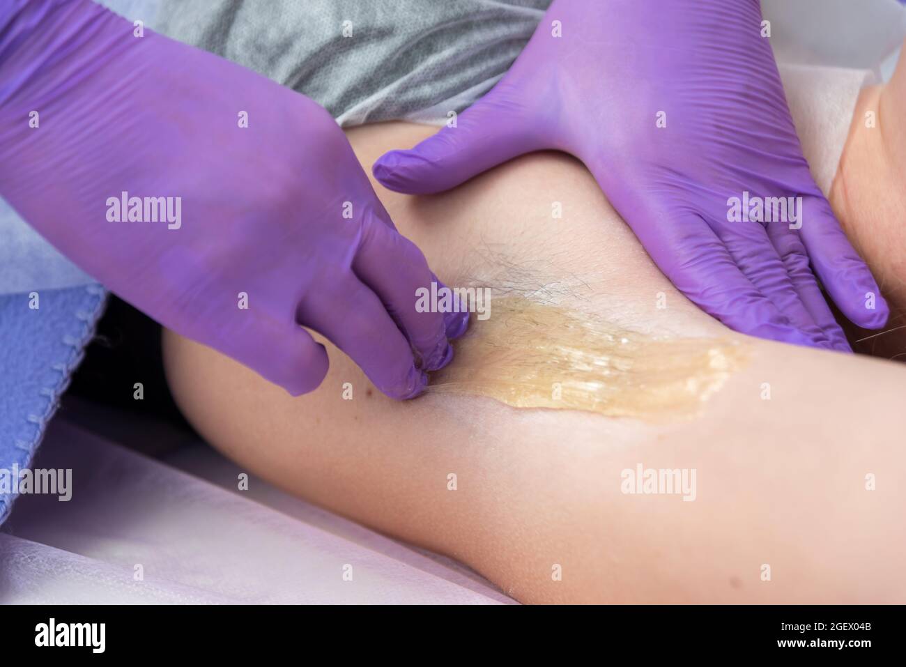 Sugaring Haarentfernung Konzept. Prozess Enthaarung von Achselmädchen mit Zuckerpaste im Spa-Salon, weißer Hintergrund. Stockfoto