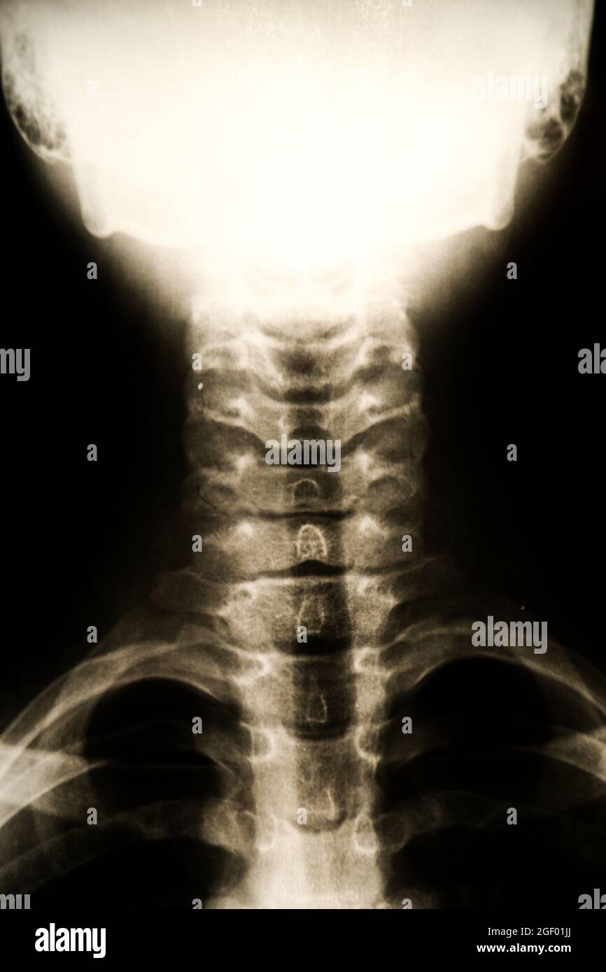Röntgenförmige Struktur am Hals Stockfoto