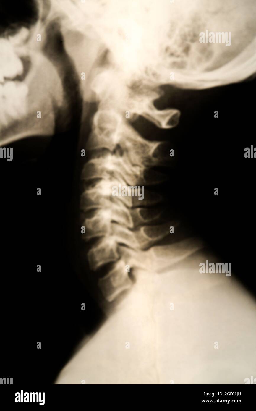 Röntgenförmige Struktur am Hals Stockfoto