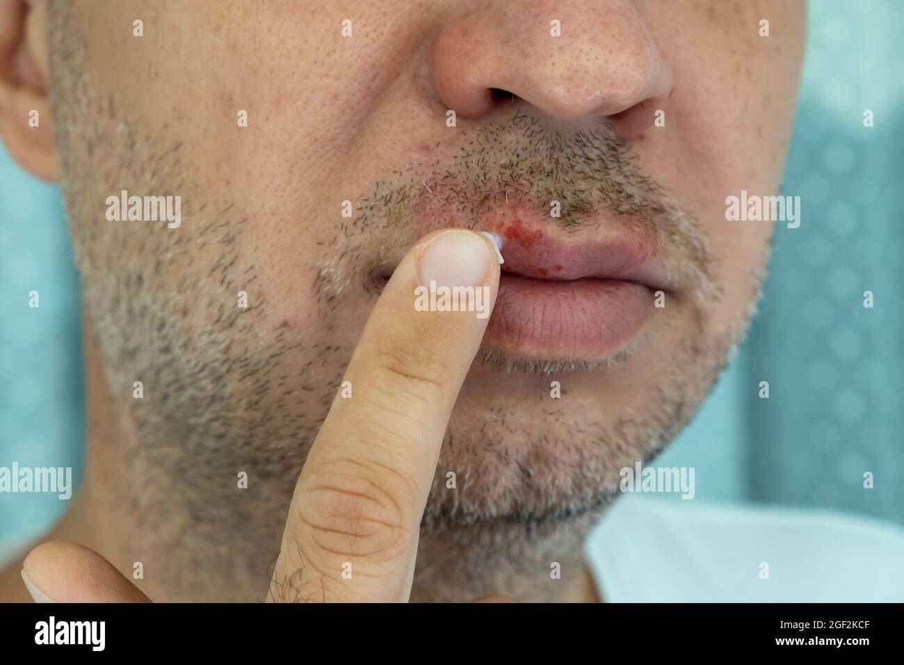 Der Mensch trägt eine Creme auf Herpes-Virus-Infektion auf der Lippe mit seinem Finger. Medizinische Versorgung Foto Stockfoto