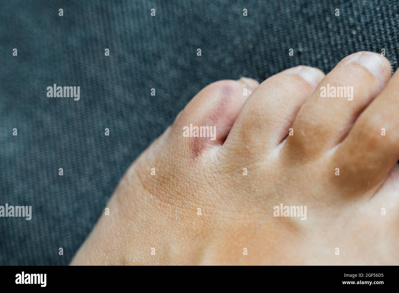 Fußverletzung mit kleinen Fingern. Kleine Zehen Schmerzen und Blutergüsse nach Hausunfall. Fraktur des Kluftbeins. Barfuß Fingernägel gesund. Stockfoto
