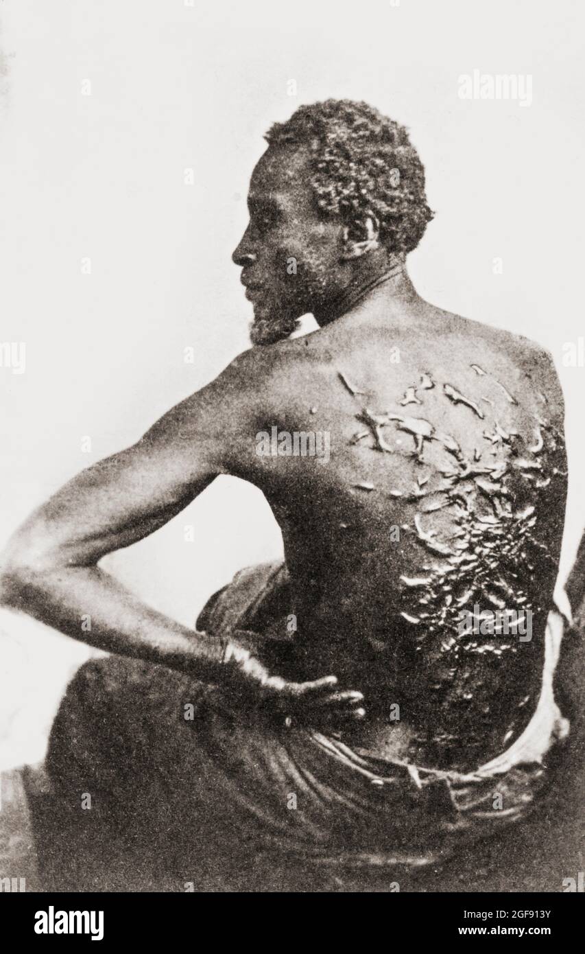 Der Gegeißelte Rücken. Die vernarbte Rückseite eines afroamerikanischen Sklaven namens Gordon, der aus Mississippi entfloh und 1863 ein Lager der Union Army in Louisiana erreichte. Das Foto wird zwei Fotografen zugeschrieben, McPherson und Oliver, die zu dieser Zeit im Lager waren. Es wurde zu einem der bekanntesten Fotos des Bürgerkrieges und zu einer mächtigen Waffe für Abolitionisten. Gordon diente im afroamerikanischen Regiment der Unionsarmee und erreichte den Rang eines Sergeanten. Stockfoto