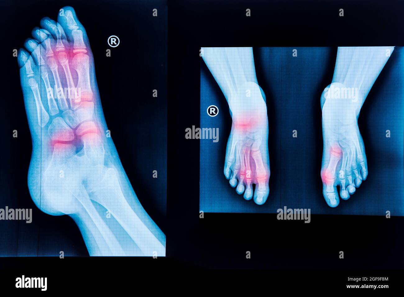 Röntgenaufnahme von menschlichen Füßen. Normale Radiographie des Fußes, medizinische Diagnostik, Traumatologie und Orthopädie Stockfoto