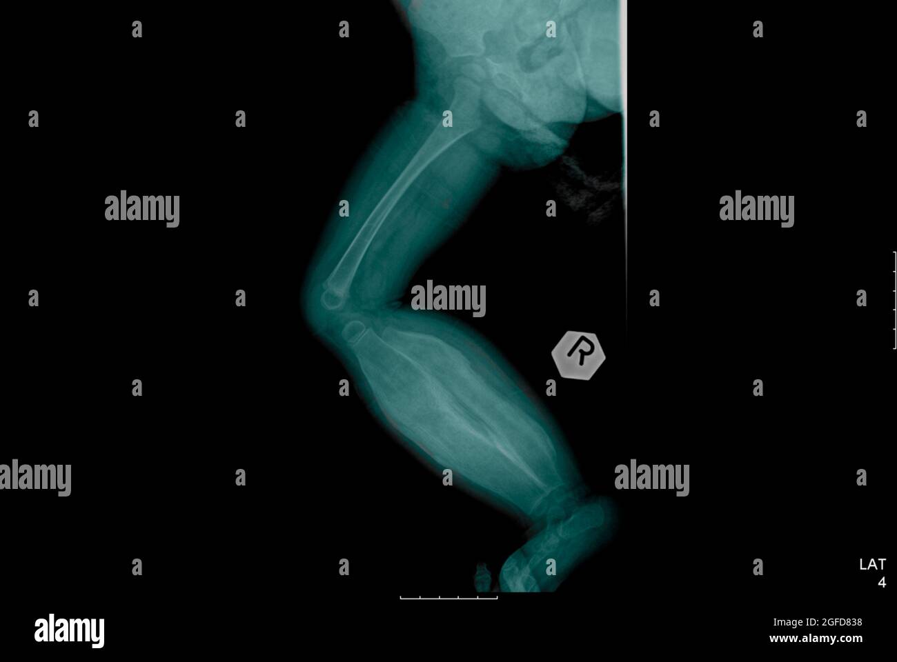 Röntgenaufnahme eines 11 Monate alten Säuglings, der an einer infantilen kortikalen Hyperostose (Caffey-Krankheit) leidet Stockfoto