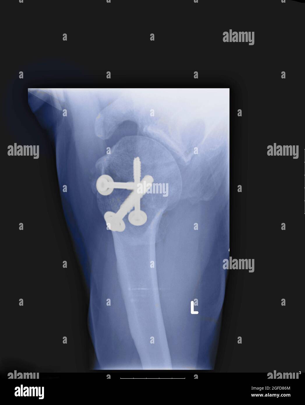 Eine 68 Jahre alte OP-Schraube an der Schulter zeigt eine Röntgenaufnahme an der Schulter, an der die veraltete Schulter befestigt ist Stockfoto