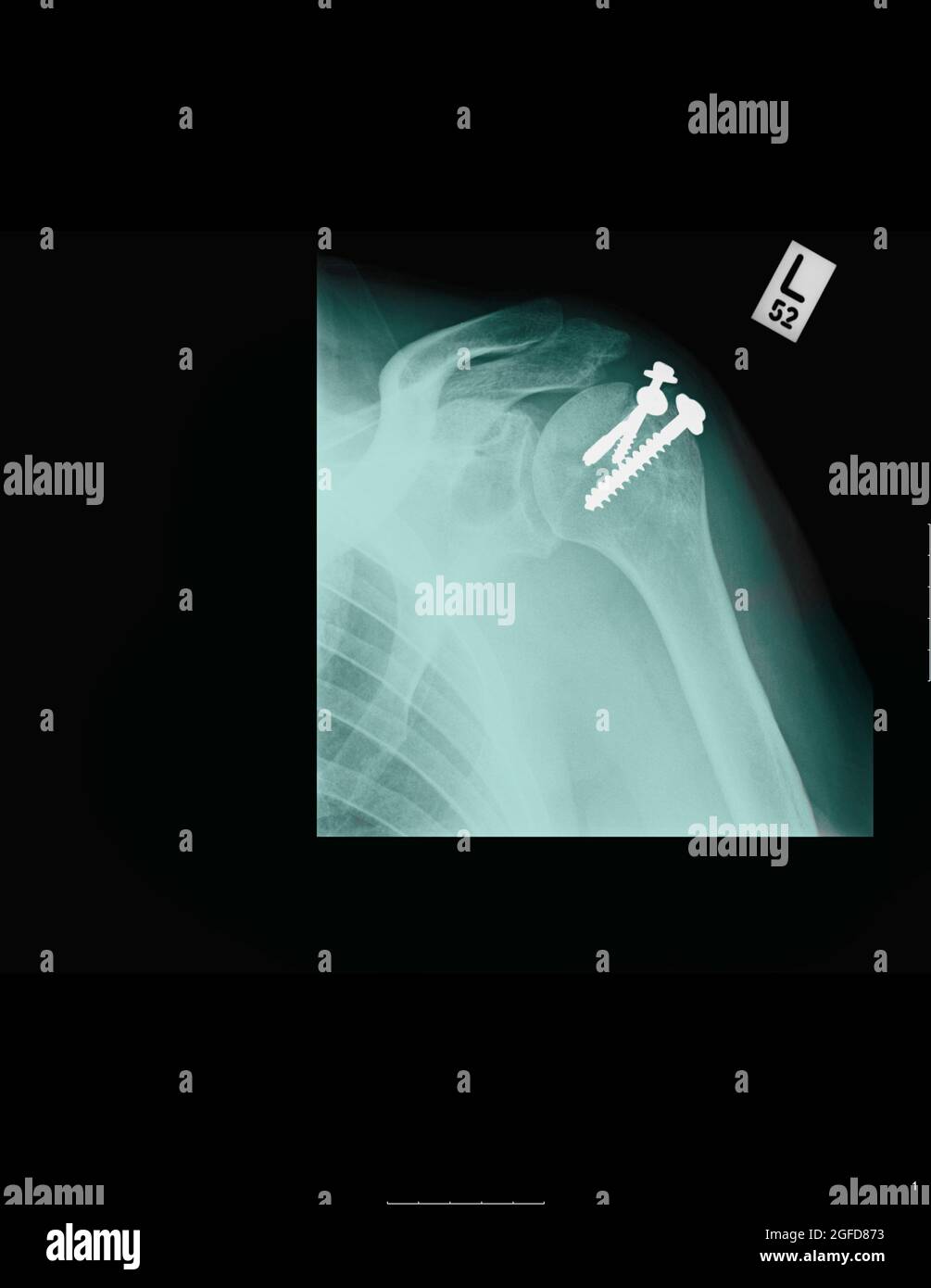 Eine 68 Jahre alte OP-Schraube an der Schulter zeigt eine Röntgenaufnahme an der Schulter, an der die veraltete Schulter befestigt ist Stockfoto