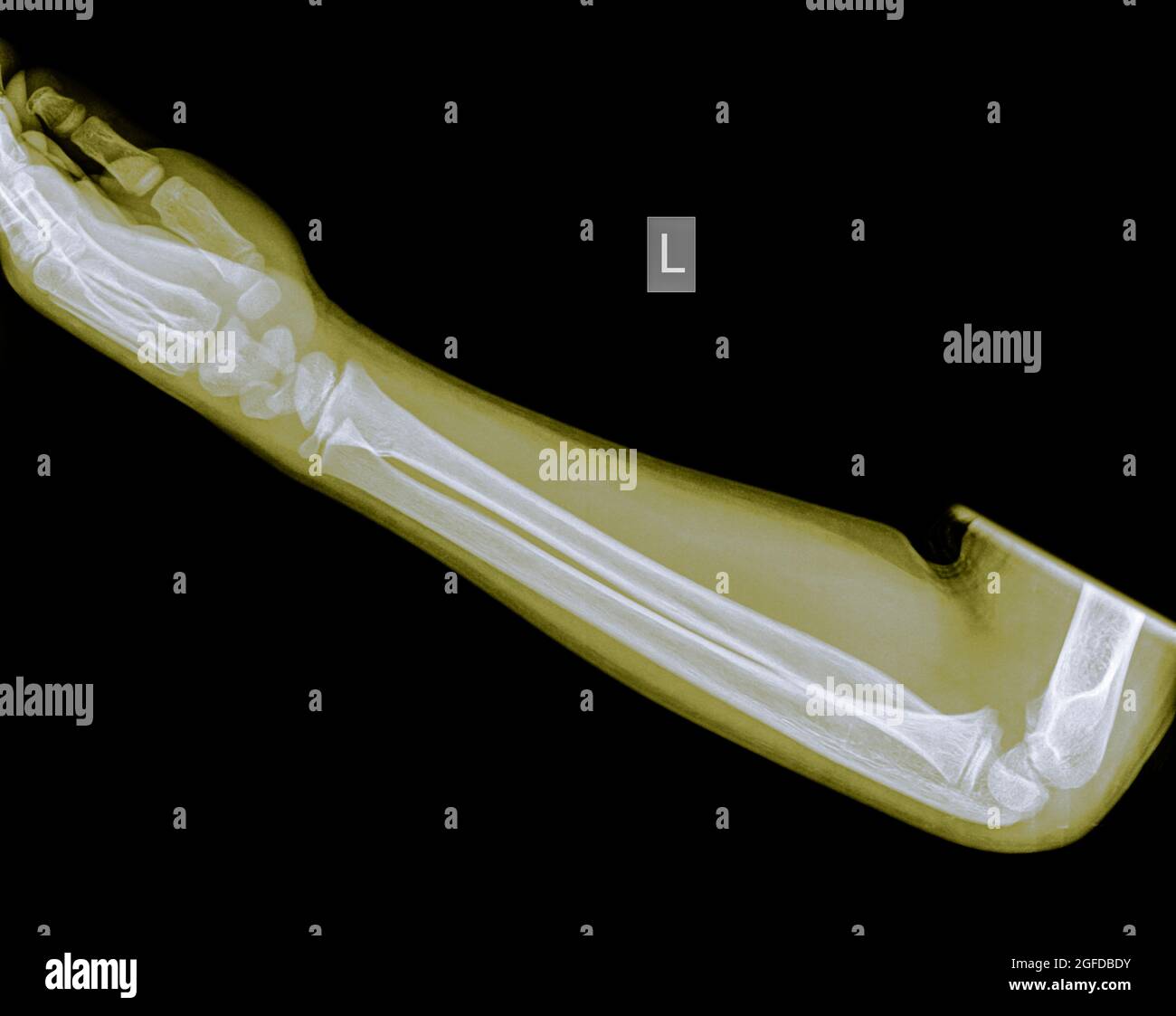 Unterarm eines 9 Jahre alten männlichen Patienten mit einer distalen Radius-Fraktur Stockfoto