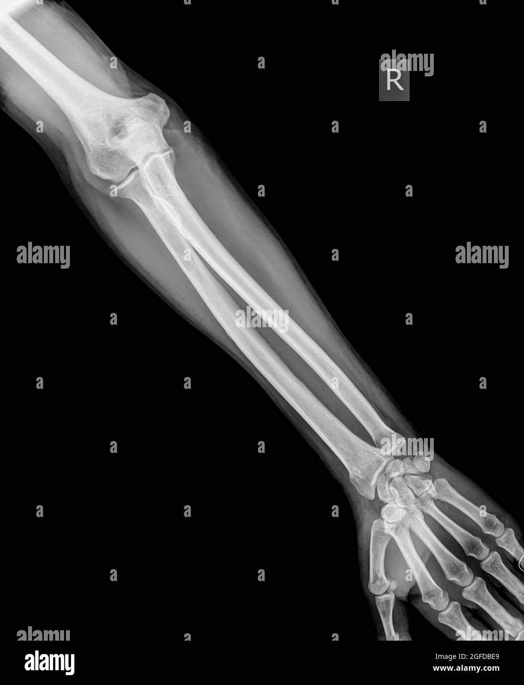 Unterarm eines 64 Jahre alten männlichen Patienten mit einer distalen Radiusfraktur Stockfoto