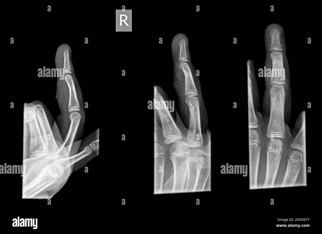 3 Ansichten des vierten Fingers der rechten Hand nach dem Leiden der Prusion mit Abrieb. Keine Fraktur oder Dislokation gesehen Stockfoto