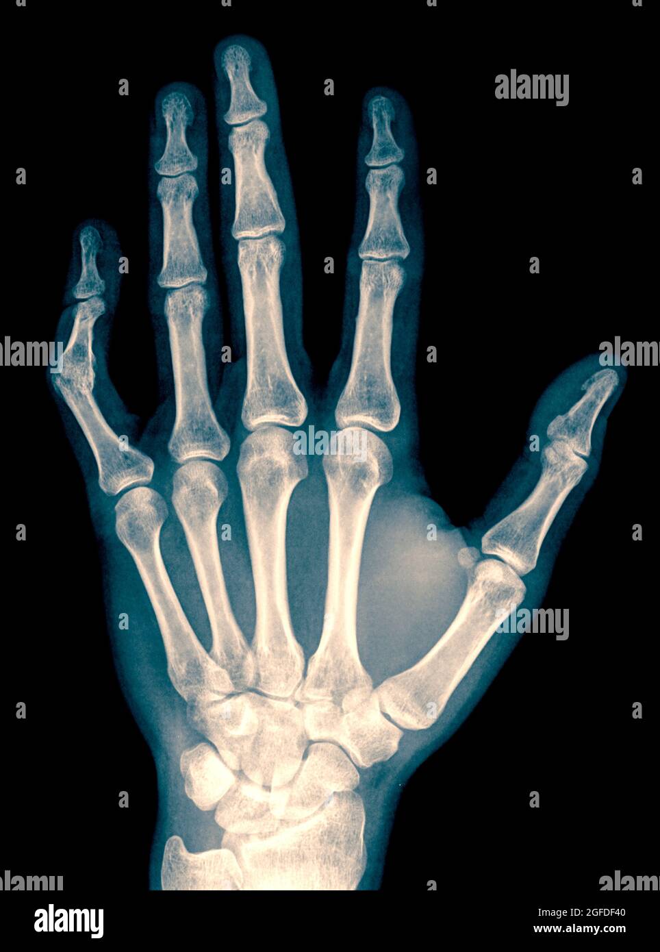 Röntgenaufnahme von Handgelenk, Hand und Fingern eines 34 Jahre alten männlichen Patienten mit einem verrenkten linken Daumen aufgrund von Pralinusbildung Stockfoto