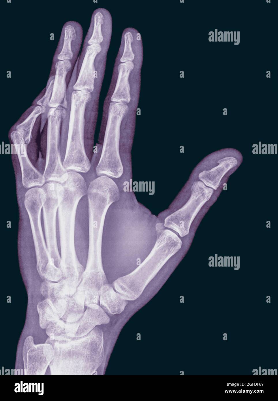 Röntgenaufnahme von Handgelenk, Hand und Fingern eines 34 Jahre alten männlichen Patienten mit einem verrenkten linken Daumen aufgrund von Pralinusbildung Stockfoto