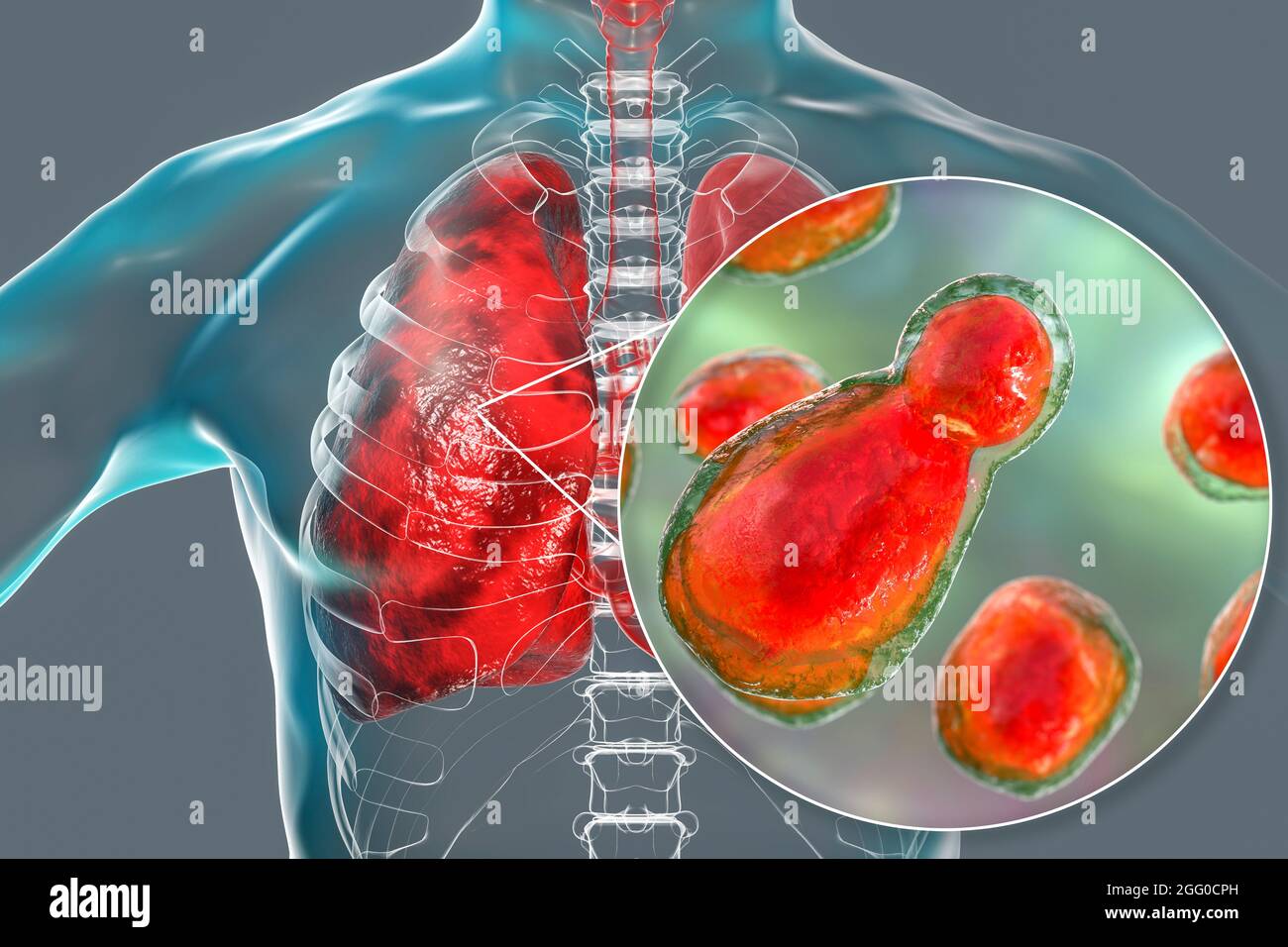 Illustration der pulmonalen Kryptokokkose, Invasion eines Lungengewebes durch Hefepilze Cryptococcus neoformans mit Nahaufnahme der Pilze. Stockfoto