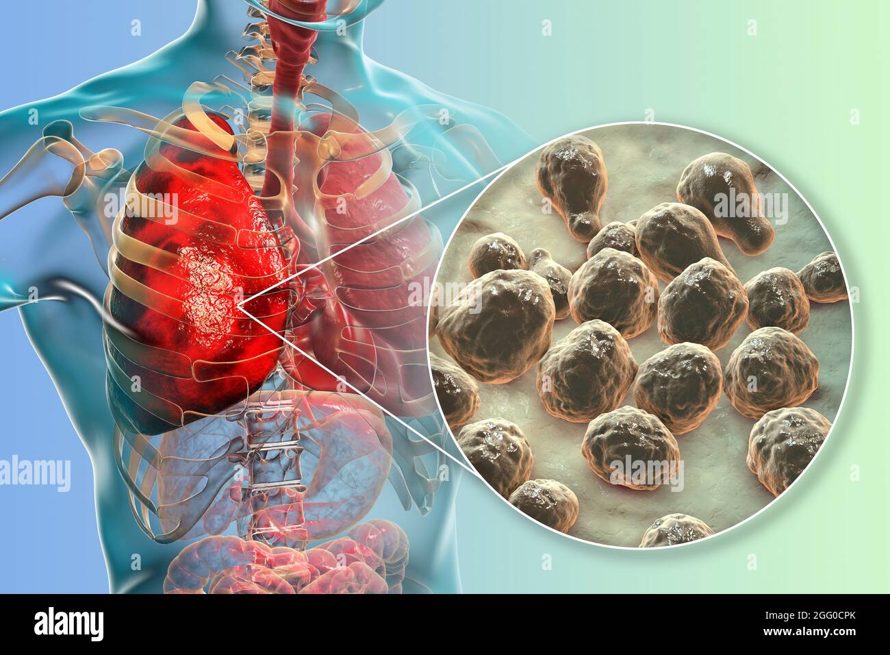 Illustration einer pulmonalen Kryptokokkose, Invasion eines Lungengewebes durch Hefepilze Cryptococcus neoformans mit Nahaufnahme der Pilze. Stockfoto