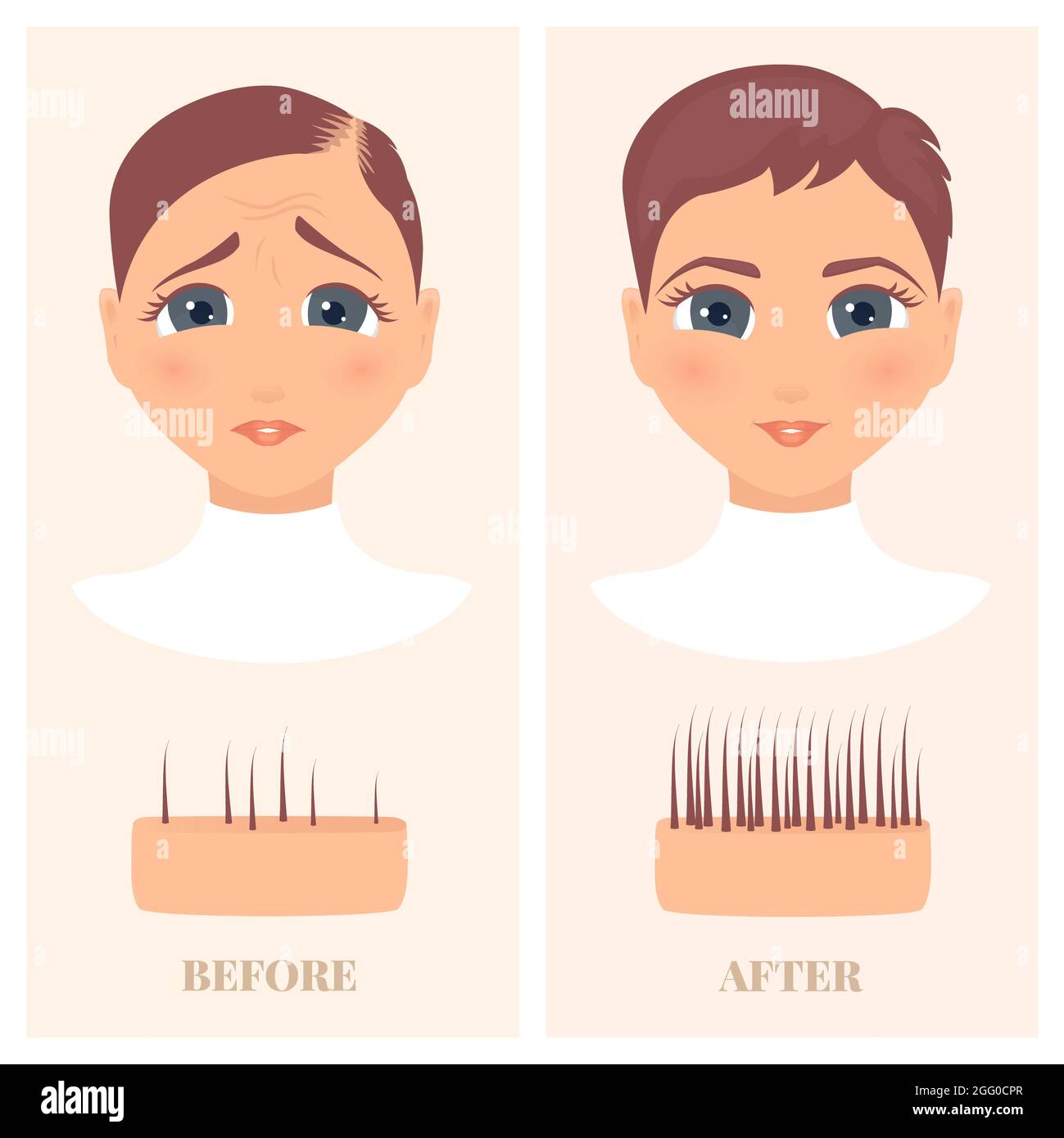 Alopezie Behandlung bei Frauen, Illustration. Frau mit dünner werdendem Haar vor und nach dem Nachwachsen der Haare. Stockfoto