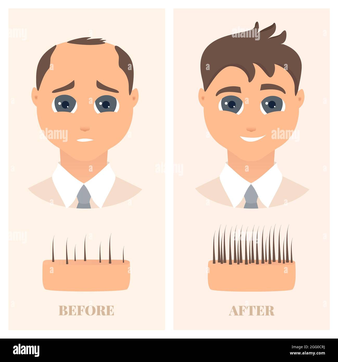 Alopezie Behandlung bei Männern, Illustration. Mann mit dünner werdendem Haar vor und nach dem Nachwachsen der Haare. Stockfoto