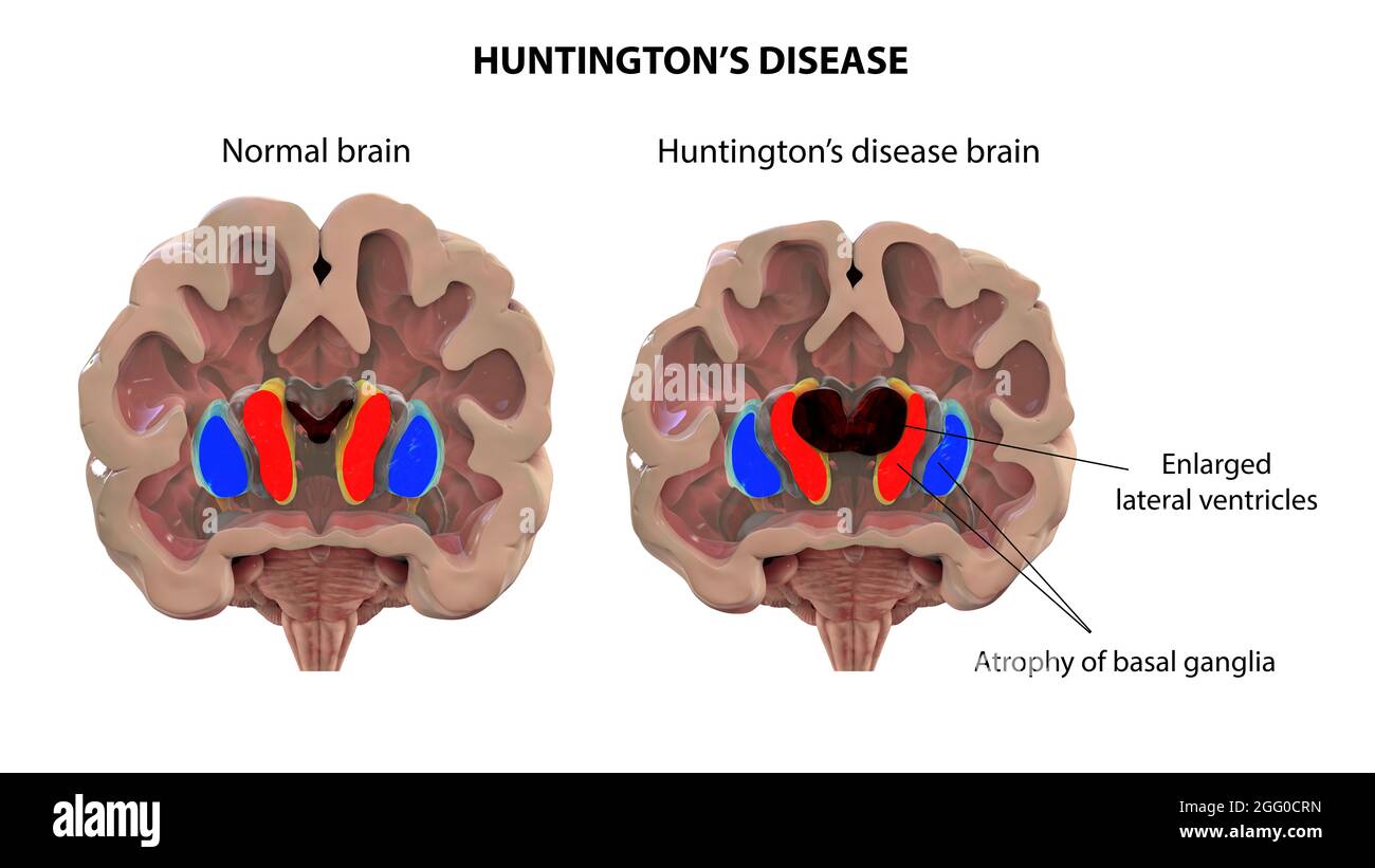 Illustration des dorsalen Striatums und der lateralen Ventrikel im gesunden Gehirn und bei der Huntington-Krankheit (HD), die Vergrößerung der vorderen Hörner der lateralen Ventrikel und Atrophie der Kaudatenkerne in HD zeigt. Stockfoto