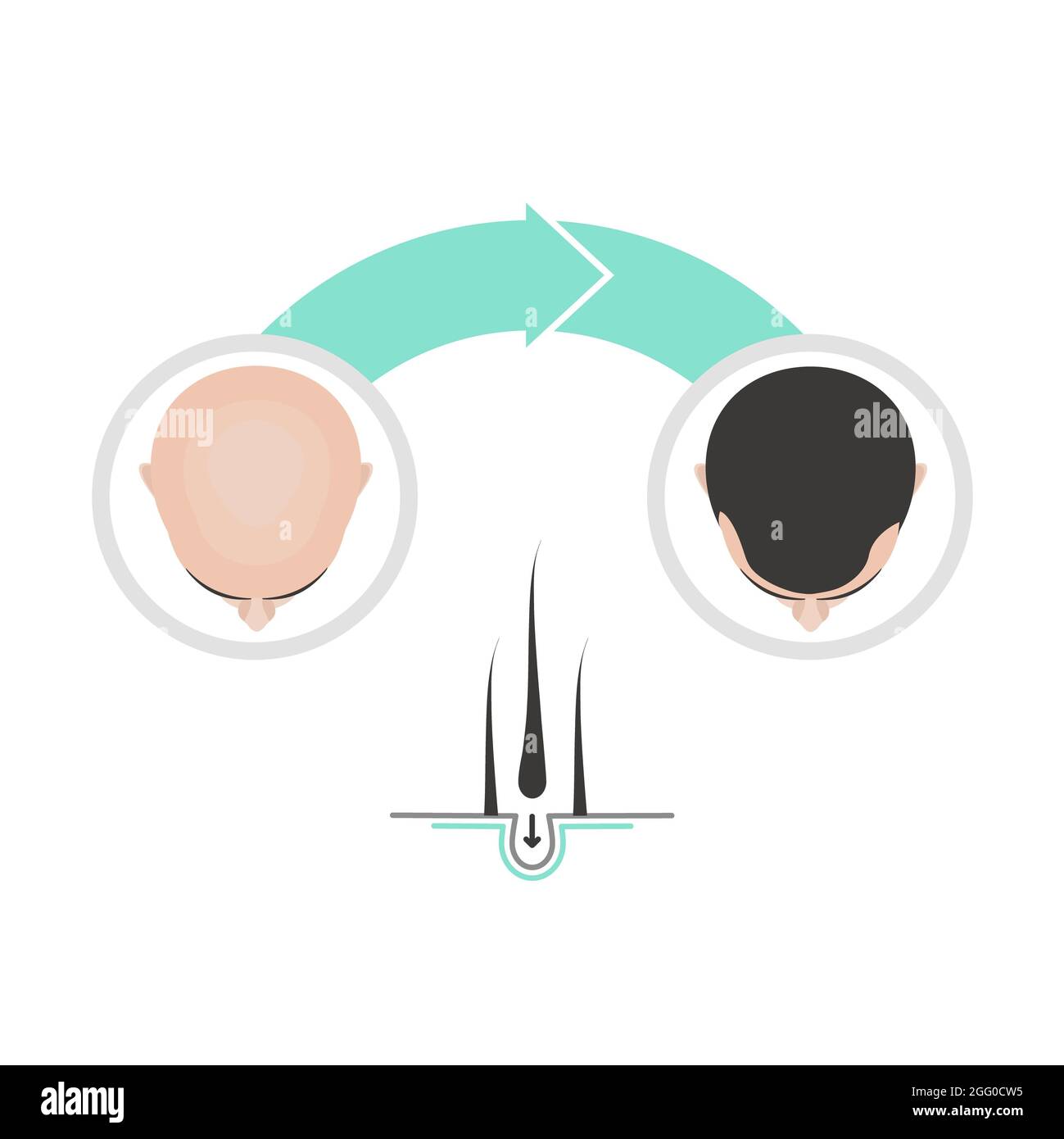 Haartransplantation für Männer, konzeptuelle Illustration. Stockfoto