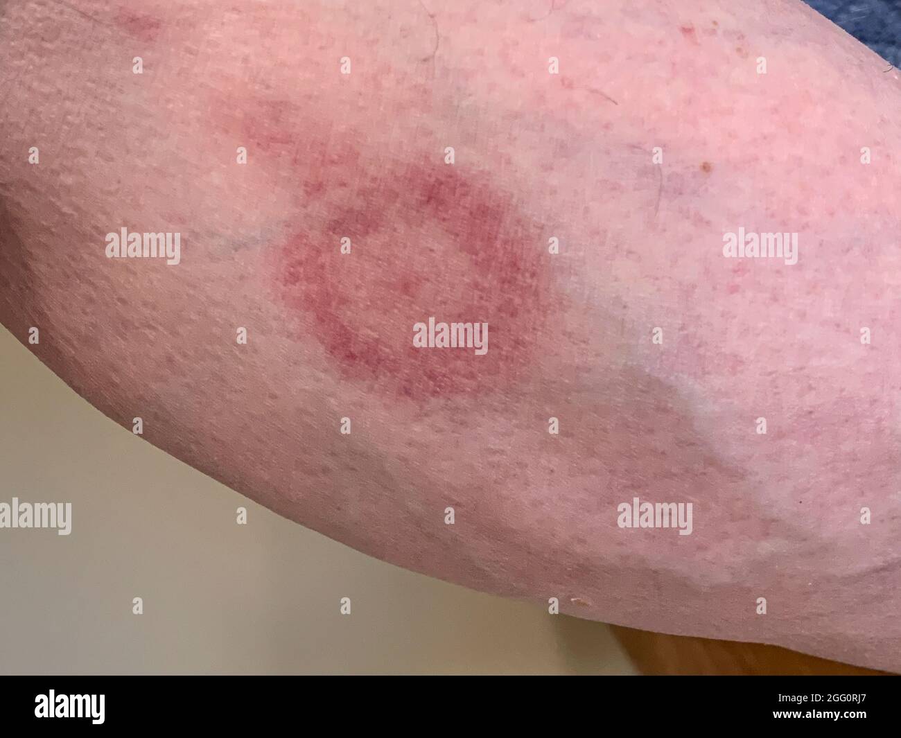 Bullseye Ausschlag auf Unterschenkel, Zeichen der Lyme-Borreliose. Neun Tage nach dem Biss. Nach fünf Tagen antibiotischer Behandlung verblassen die Farben. Stockfoto