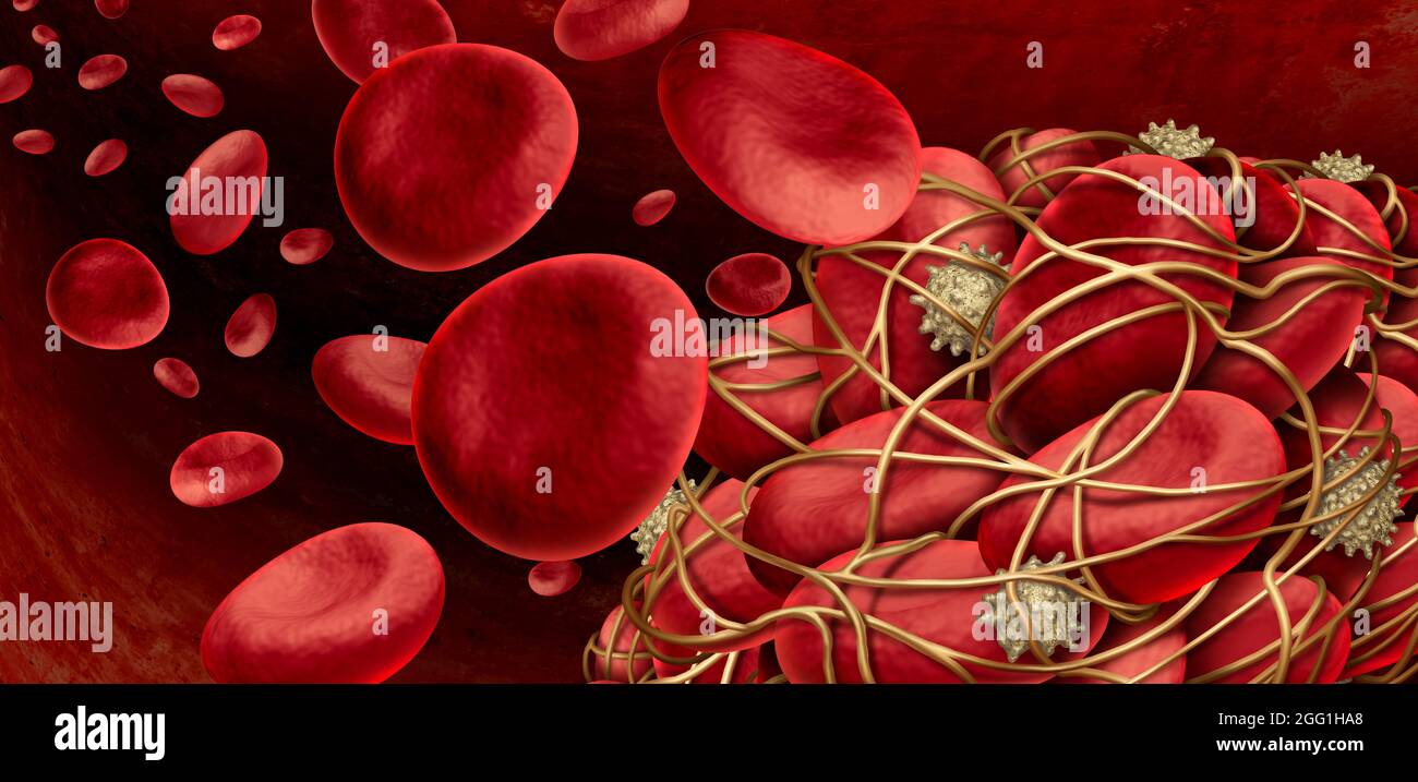 Blutgerinnsel und Thrombose medizinisches Illustrationskonzept als eine Gruppe von menschlichen Blutzellen, die durch klebrige Thrombozyten und Fibrin zusammen verklumpt bilden. Stockfoto