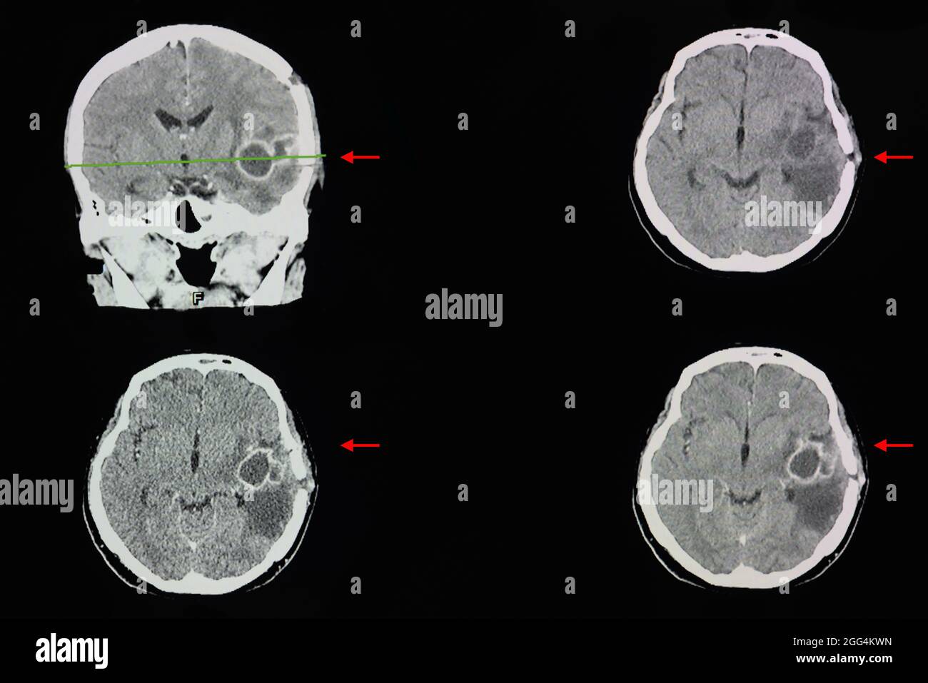 Ein CT-Hirnscan einer Patientin mit großen Hirnabszessen in ihrem linken Schläfenlappen. Stockfoto