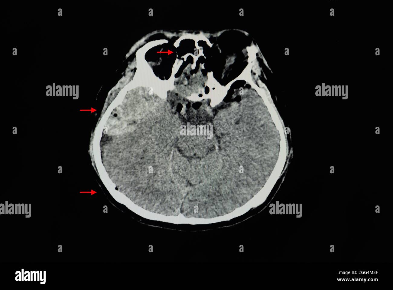 Ein CT-Hirnscan eines Patienten mit epiduralem Hämatom bei rechter temporaler Konvexität mit Masseneffekt. Spannung des Pneumocepals. Mehrere Gesichts-, Nasennebenhöhlen, ein Stockfoto
