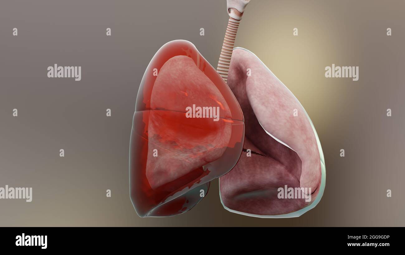 3d-Darstellung von Hämothorax, normale Lunge versus kollabiert, Symptome von Hämothorax, Pleuraerguss, Empyema, Komplikationen nach einer Brustverletzung, Stockfoto