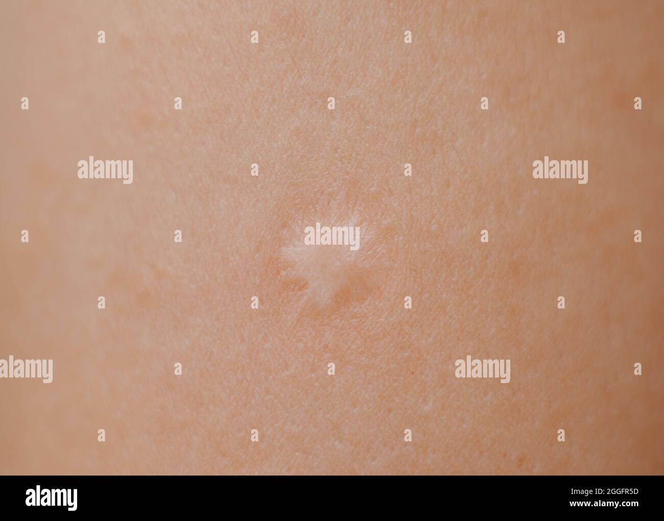 Nahaufnahme der Narbe der BCG-Impfung am menschlichen Arm. Stockfoto
