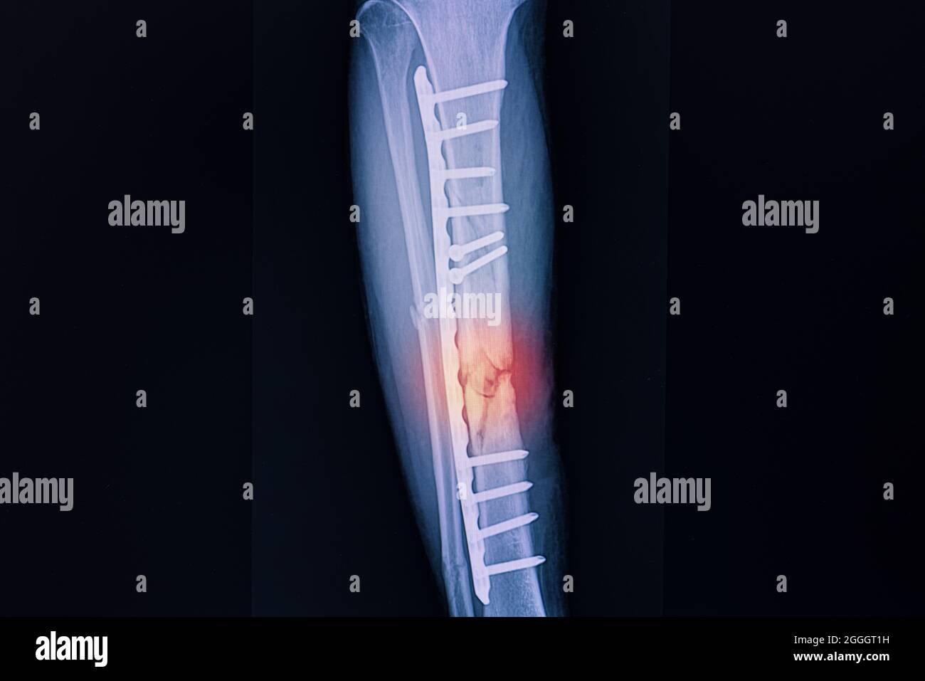 Röntgenfest eines Patienten mit Bruch der rechten Tibia nach chirurgischer Fixierung mit Metallplatten und Schrauben. Stockfoto