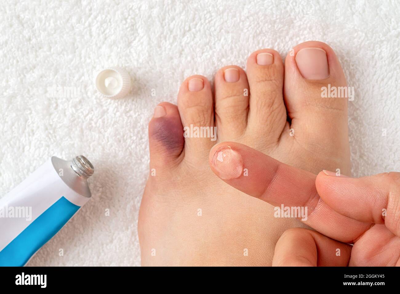Gel für Prellungen am Zeigefinger über dem gequetschten Zeh des weiblichen Fußes. Verletzung eines kleinen Fingers nach einem Unfall. Gebrochener rosafarbiger Zeh. Oben. Stockfoto