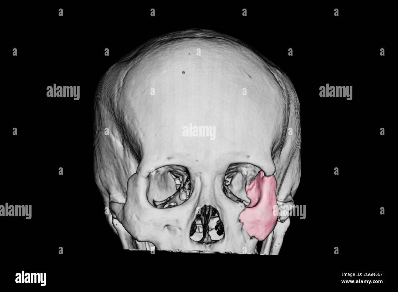 3-D-Nachderfilm eines Schädels eines Patienten mit traumatischer Hirnverletzung, der einen gebrochenen zygomatischen Knochen zeigt (rosa Bereich) Stockfoto