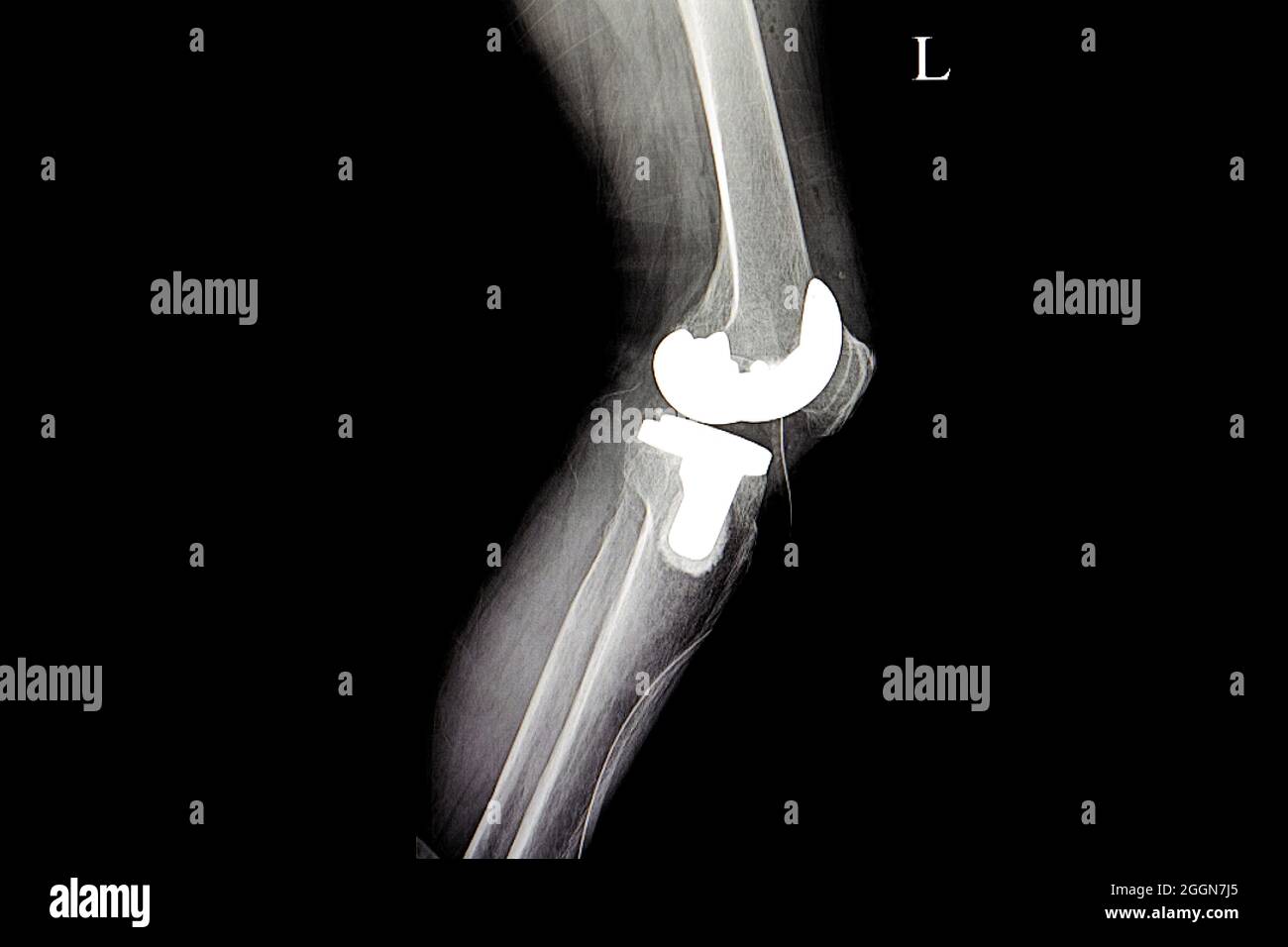 Röntgenfilm eines Patienten mit totaler Kniegelenkersetzung Stockfoto