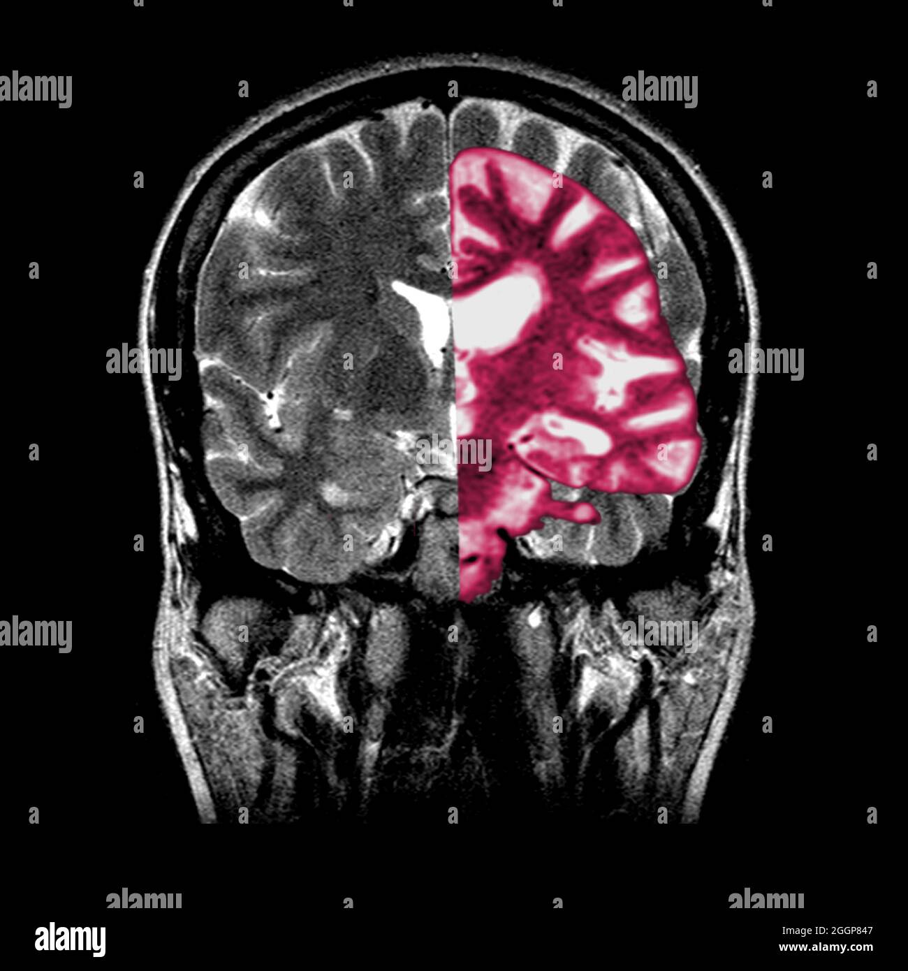 Ein zusammengesetztes Bild, das ein normales koronales (frontales) Querschnitt-MRT-Bild des Gehirns (in Graustufen) mit einem überlagerten koronalen MRT-Bild eines Gehirns mit fortgeschrittener Alzheimer-Erkrankung (in Pink) zeigt. Das erkrankte Gehirn zeigt eine schwere generalisierte Atrophie (Schrumpfung) des Hirngewebes mit einem akzentuierten Gewebeverlust, der die Temporallappen umfasst. Stockfoto