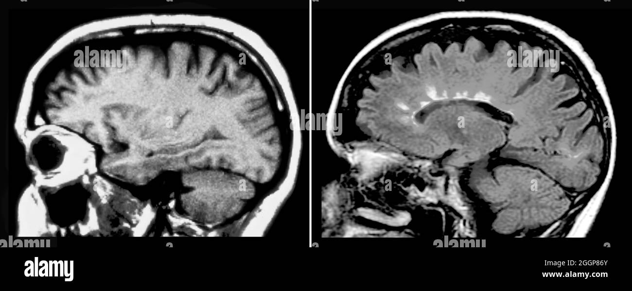 MRT des normalen Gehirns (links) und eines mit multipler Sklerose (rechts). Stockfoto