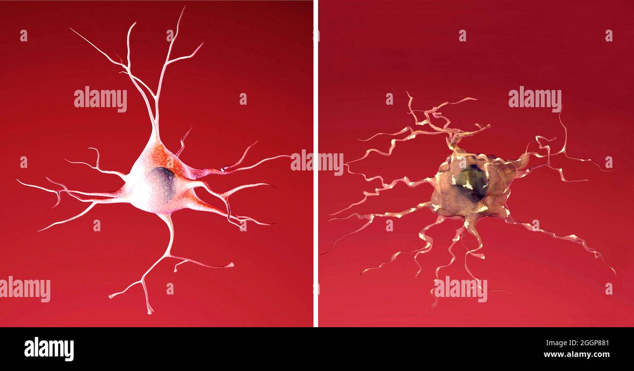 Illustration von normalen (linken) und sterbenden (rechten) Neuronen. Stockfoto