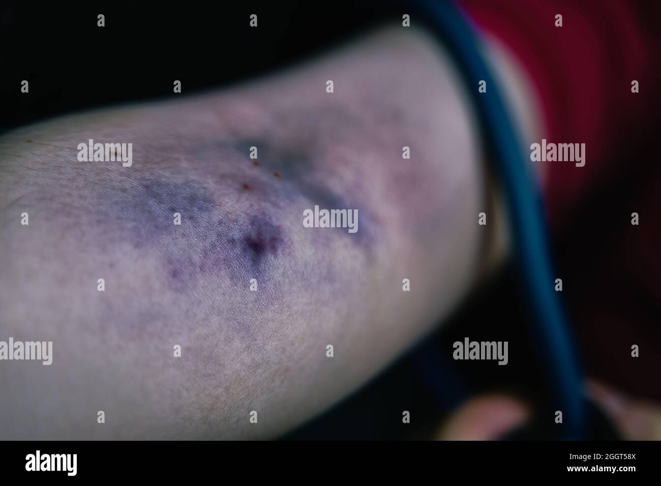 Der Arm der Frau ist durch die Einnahme von intravenösem Betäubungsmittel verletzt. Drogenabhängiger zieht das Tourniquet am Arm. Nahaufnahme des großen Bluthämatoms. Konzept von Verzweiflung und Depression. Sucht nach illegalen Substanzen. Stockfoto