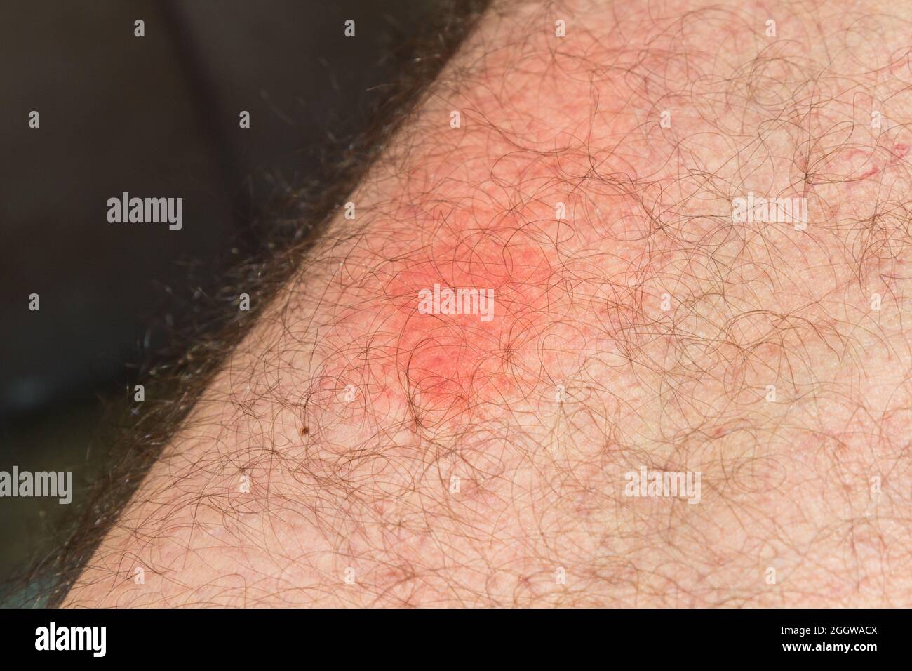 Wespe sticht nach einem Tag auf die Haut, rote Entzündungsflecken durch Wespenstich Stockfoto