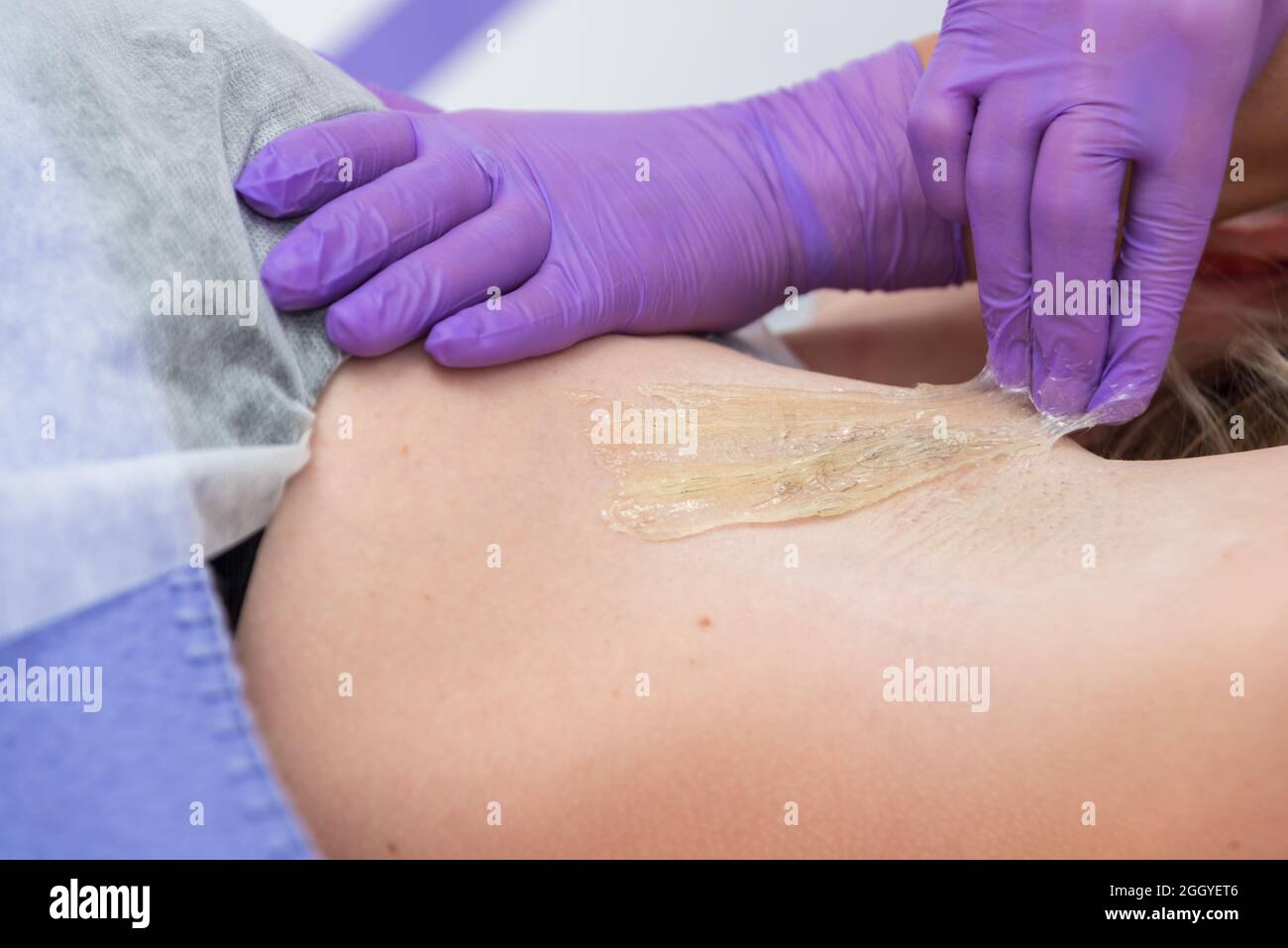 Sugaring Haarentfernung Konzept. Prozess Enthaarung von Achselmädchen mit Zuckerpaste im Spa-Salon, weißer Hintergrund. Stockfoto