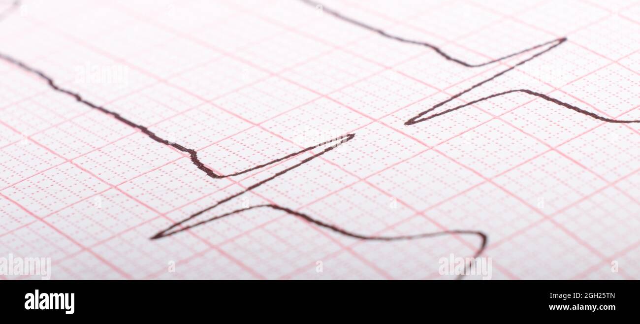 ekg-Kardiogramm der Herzimpulse aus der Nähe, Hypertonie-Behandlung. Stockfoto