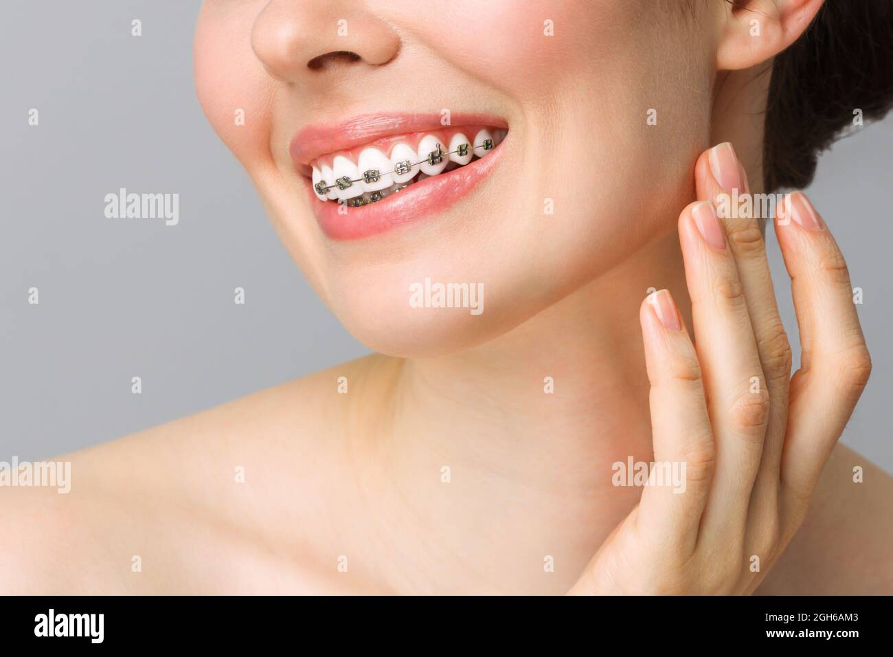 Kieferorthopädische Zahnpflege Konzept. Frau gesund Lächeln Nahaufnahme. Nahaufnahme Keramik- und Metallhalterungen an den Zähnen. Schönes Lächeln mit Zahnspangen. Stockfoto