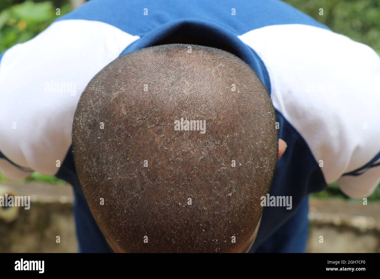 Mann mit kahlem Kopf mit sichtbarer Schuppen, Schuppen am Kopf, Trockenheitsprobleme der Kopfhaut Stockfoto