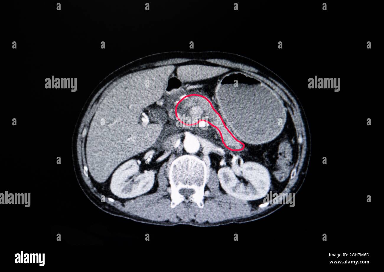 CT-Scan des Abdomens eines Patienten mit Karzinom des Kopfes der Bauchspeicheldrüse. Stockfoto