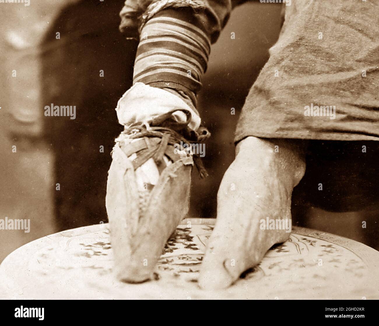 Gebundene Füße, Chine, Anfang des 20. Jahrhunderts Stockfoto