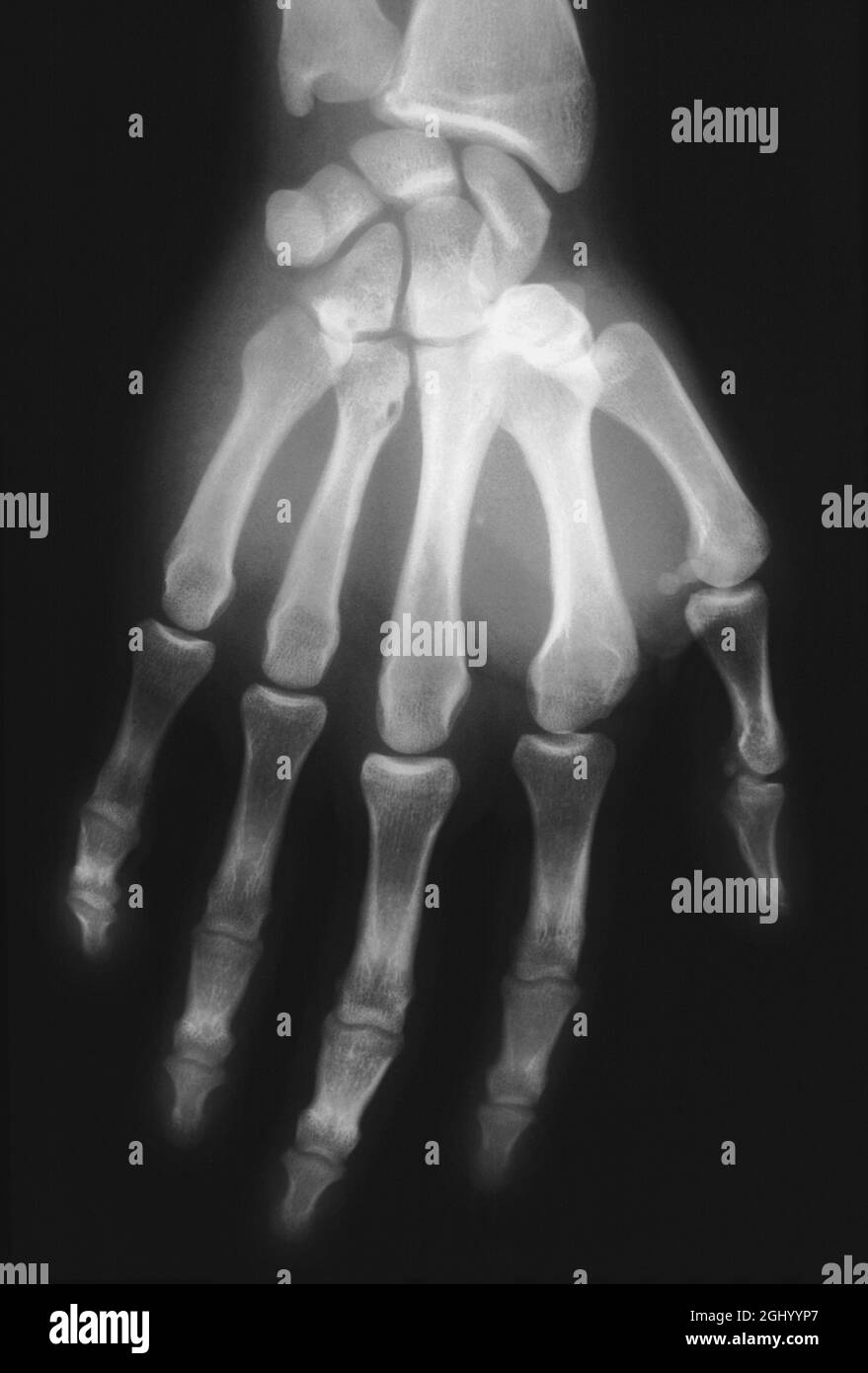 Medizinisch - Röntgenaufnahme einer menschlichen Hand, die die Karpelle, die Metacarpale und die Knochen des Pals zeigt. Stockfoto