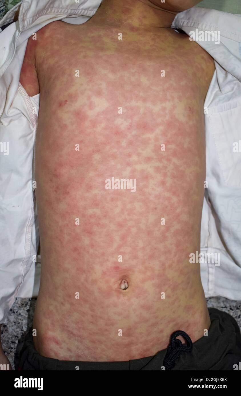Chikungunya-Ausschlag über dem Stamm eines asiatischen Kindes. Weit verbreitete makolopapuläre Hautläsionen. Stockfoto