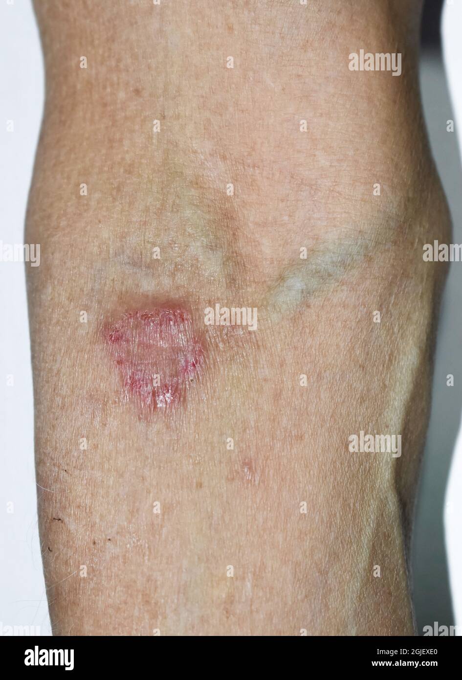 Tinea corporis oder Ringwurm. Juckende Hautläsionen an den oberen Extremitäten der älteren asiatischen Frau. Stockfoto